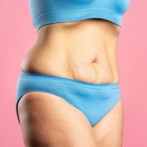 How to Get Rid of an Apron Belly: Causes and Solutions for a Flatter Stomach