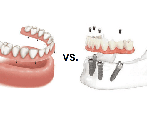 Implants vs. Dentures: Functions, Structure, and Costs