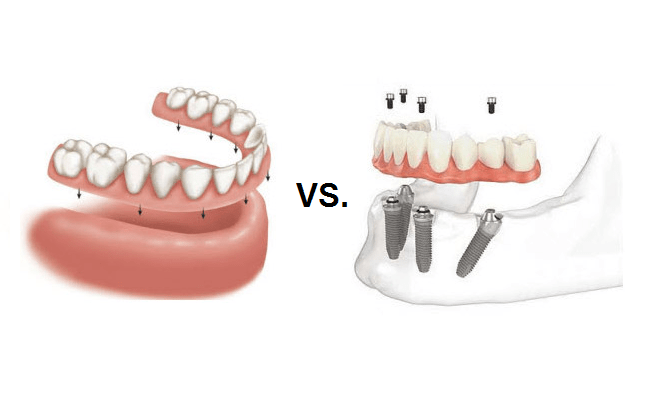 Implants vs. Dentures: Functions, Structure, and Costs 1 Implants vs. Dentures: Functions, Structure, and Costs