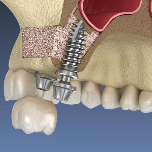 Is a Sinus Lift Required for Dental Implants?