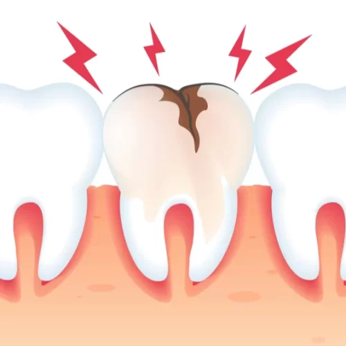 Repairing a Chipped Tooth: Your Complete Guide to Treatment Options