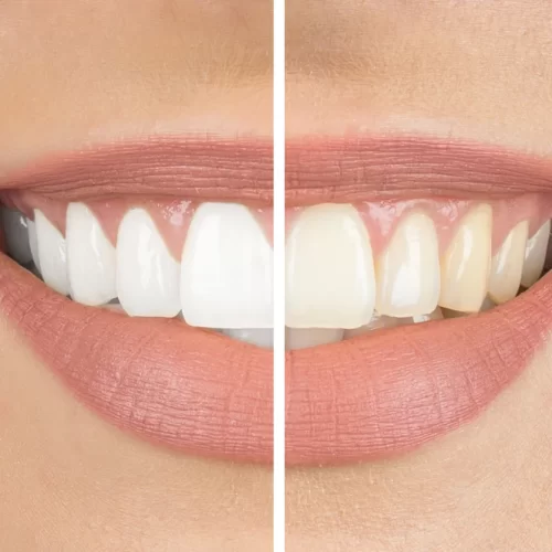 Teeth Stains: 4 Natural Remedies for a Brighter Smile