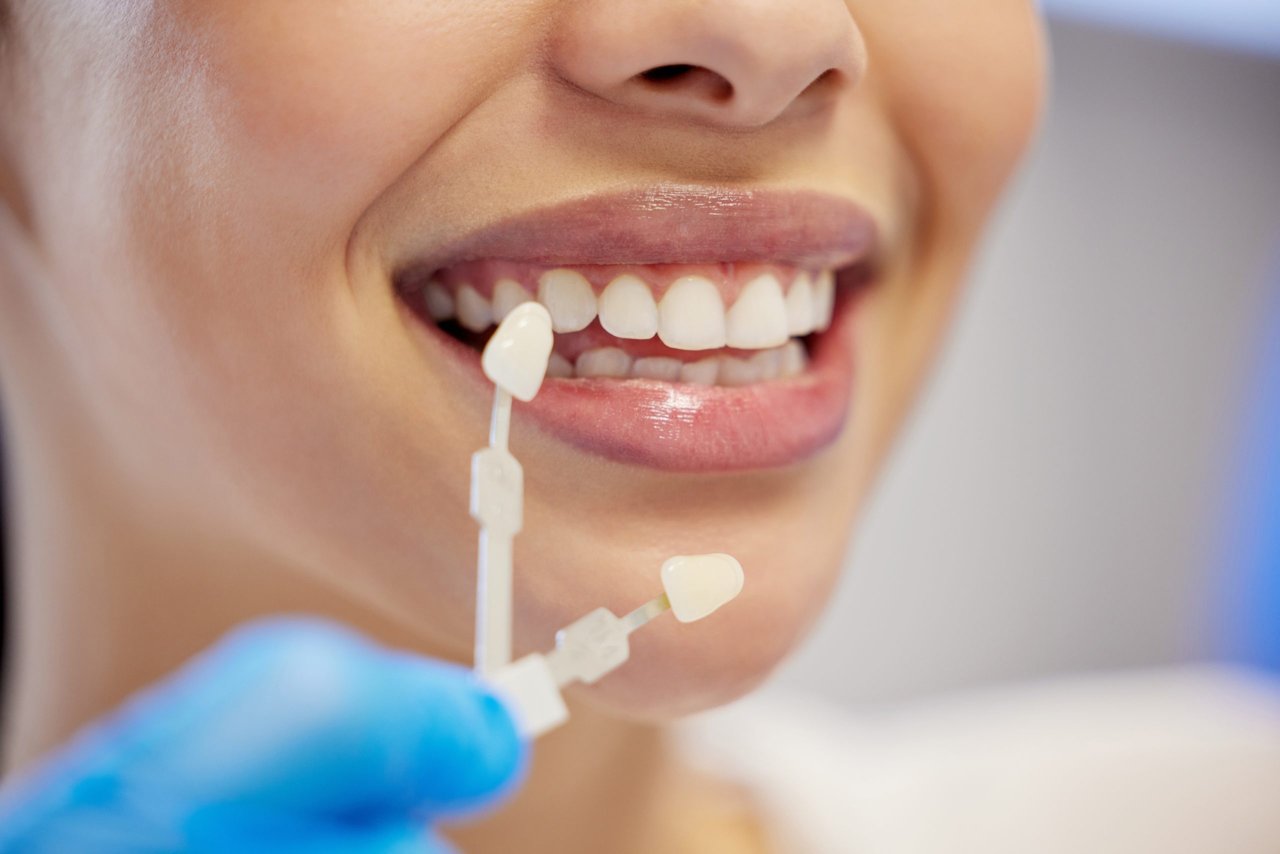 The Cost of Porcelain Veneers: 3 Key Factors Influencing Pricing 1 The Cost of Porcelain Veneers: 3 Key Factors Influencing Pricing