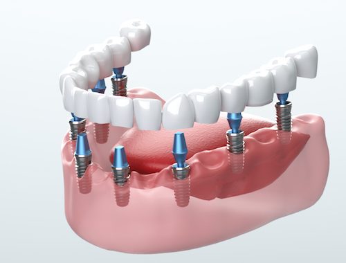 Top 5 Things You Need to Do Before Your Dental Implant Treatment