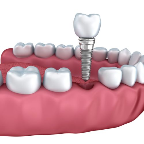 Top Replacement Options After Tooth Extraction: A Comprehensive Guide