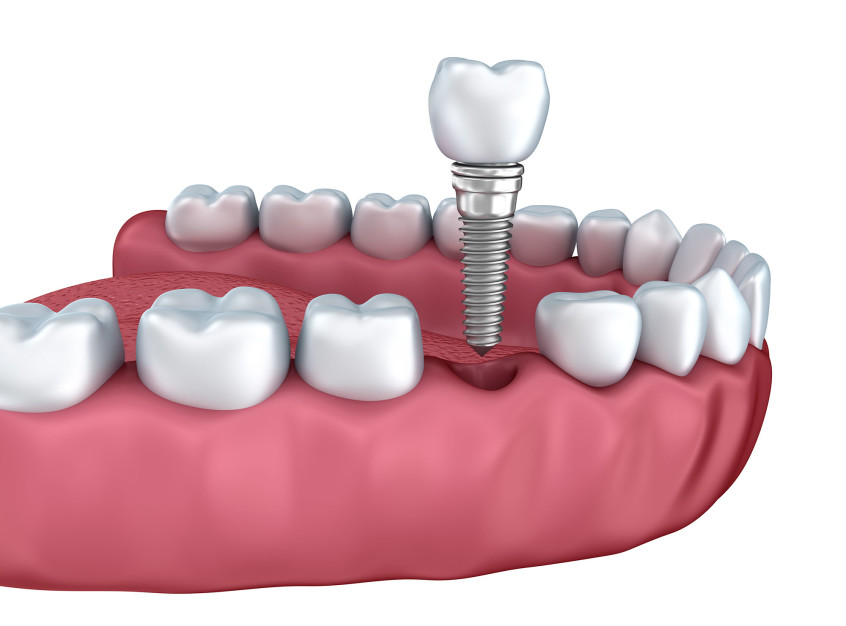 Top Replacement Options After Tooth Extraction: A Comprehensive Guide 1 Top Replacement Options After Tooth Extraction: A Comprehensive Guide