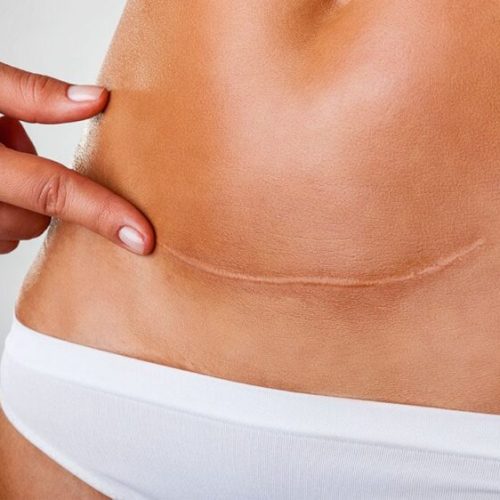 Tummy Tuck Scars: Types, Healing Process, and How to Fix with Scar Revision Surgery