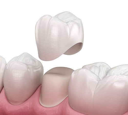 Understanding Dental Crowns: What They Are and How They Work