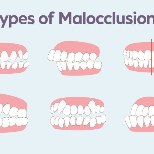 Understanding Malocclusion: Types, Causes, and Effective Treatment Options