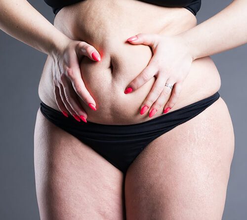 Understanding Tummy Tuck Surgery Risk Factors and Life Expectancy