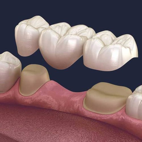 Understanding the Dental Crown Procedure: A Step-by-Step Guide