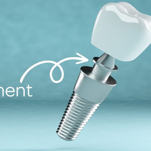 What Is a Dental Implant Abutment? Understanding Its Role and Importance