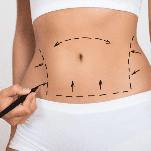 What Is a Drainless Tummy Tuck?