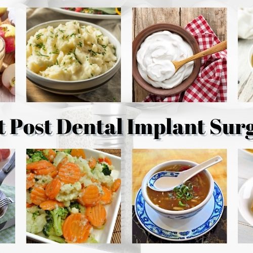 What to Eat After Dental Implant Surgery: A Comprehensive Guide