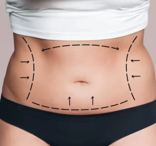 What to Expect From a Tummy Tuck 20 Years Later