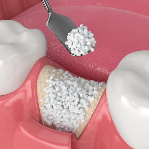 When Can You Get a Dental Implant After a Bone Graft?