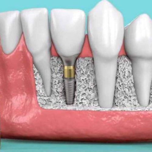 Why No Dairy Products After Dental Implant Surgery?