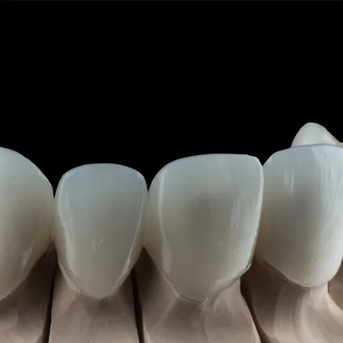 Zirconia Crowns: A Comprehensive Guide