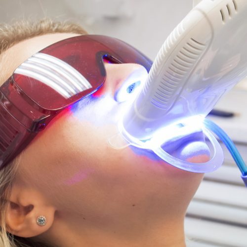 Zoom Teeth Whitening: 6 Key Insights You Should Know